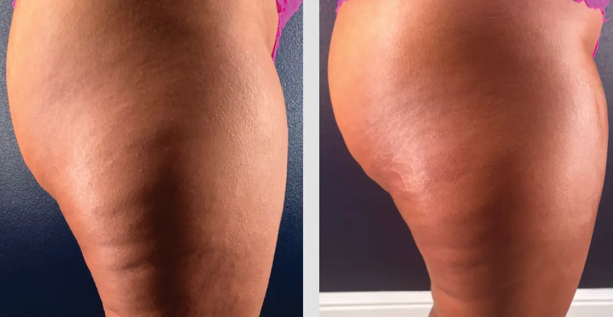 Cellulite reduction and contouring before and after, one session, showing obvious smoothing, reduced dimples, and a tighter shape 