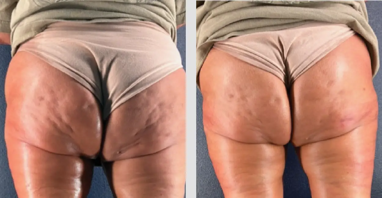 Before and after Cellulite reduction, after two sessions, showing a huge reduction in cellulite depth and severity