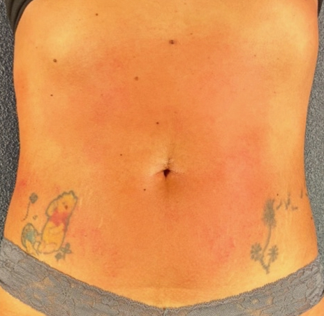 Flat-Stomach Core Reset - after