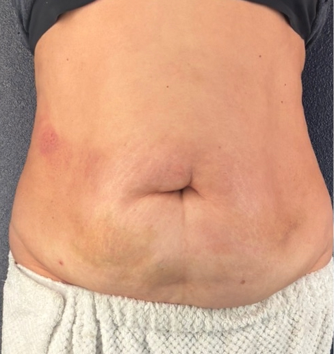 Gut Relief + Major Core Volume Drop - after