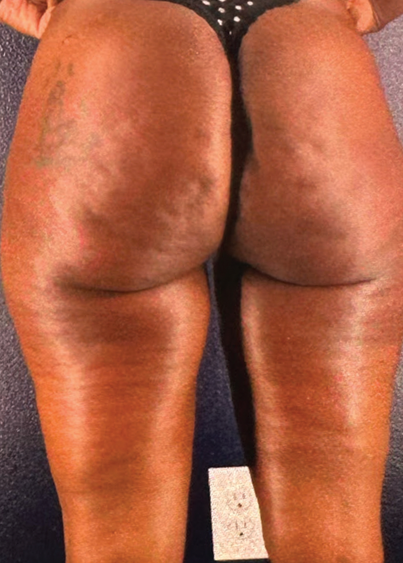 Shape Lift + Dimple Smoothing - after